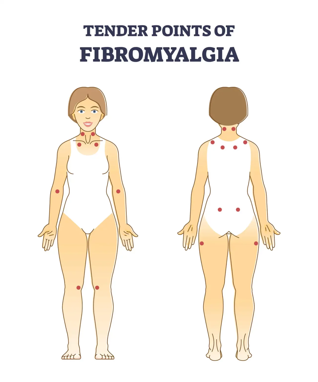 tender points, also called trigger points, of Fibromyalgia 