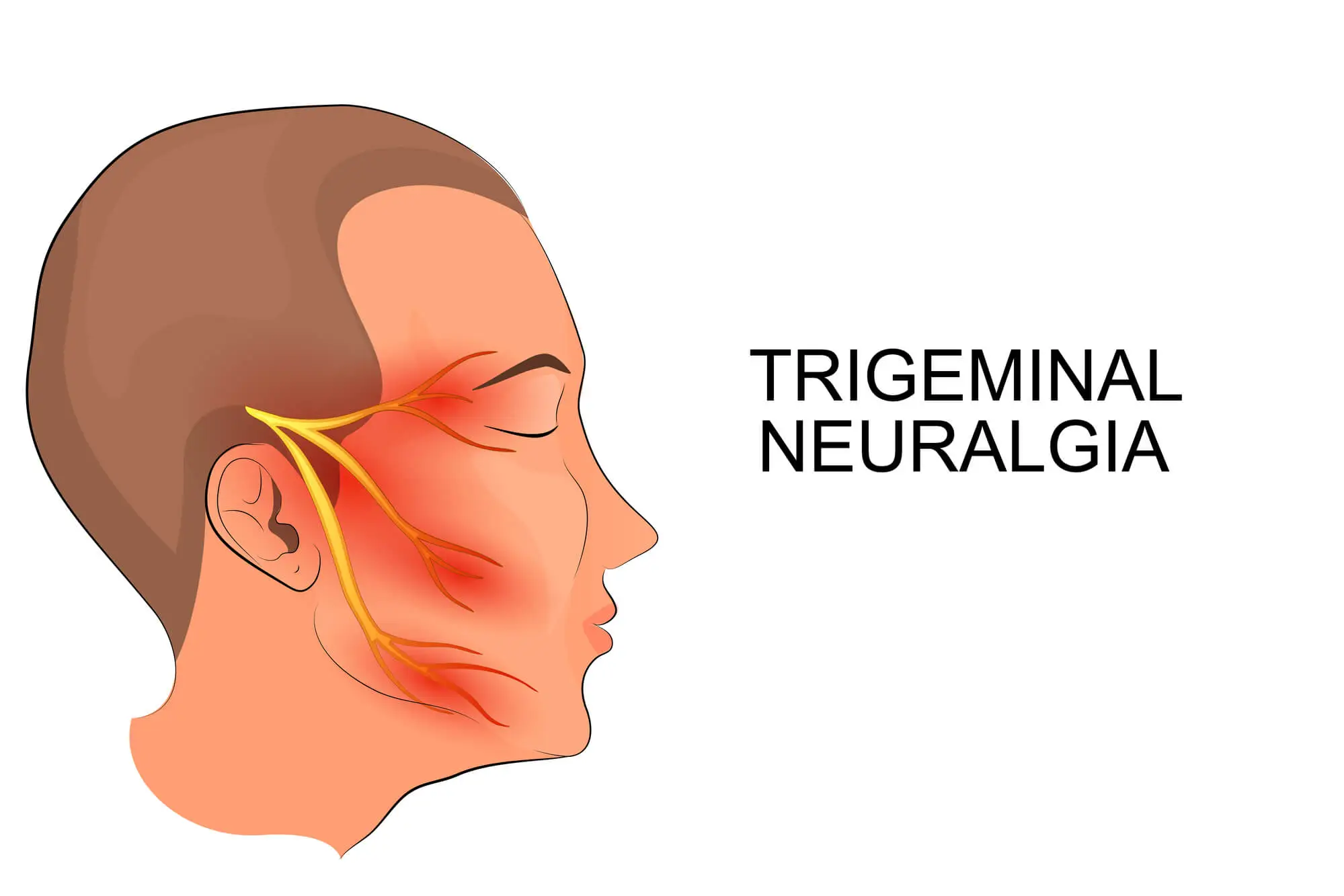 Affected areas on side of face of those suffering from trigeminal neuralgia