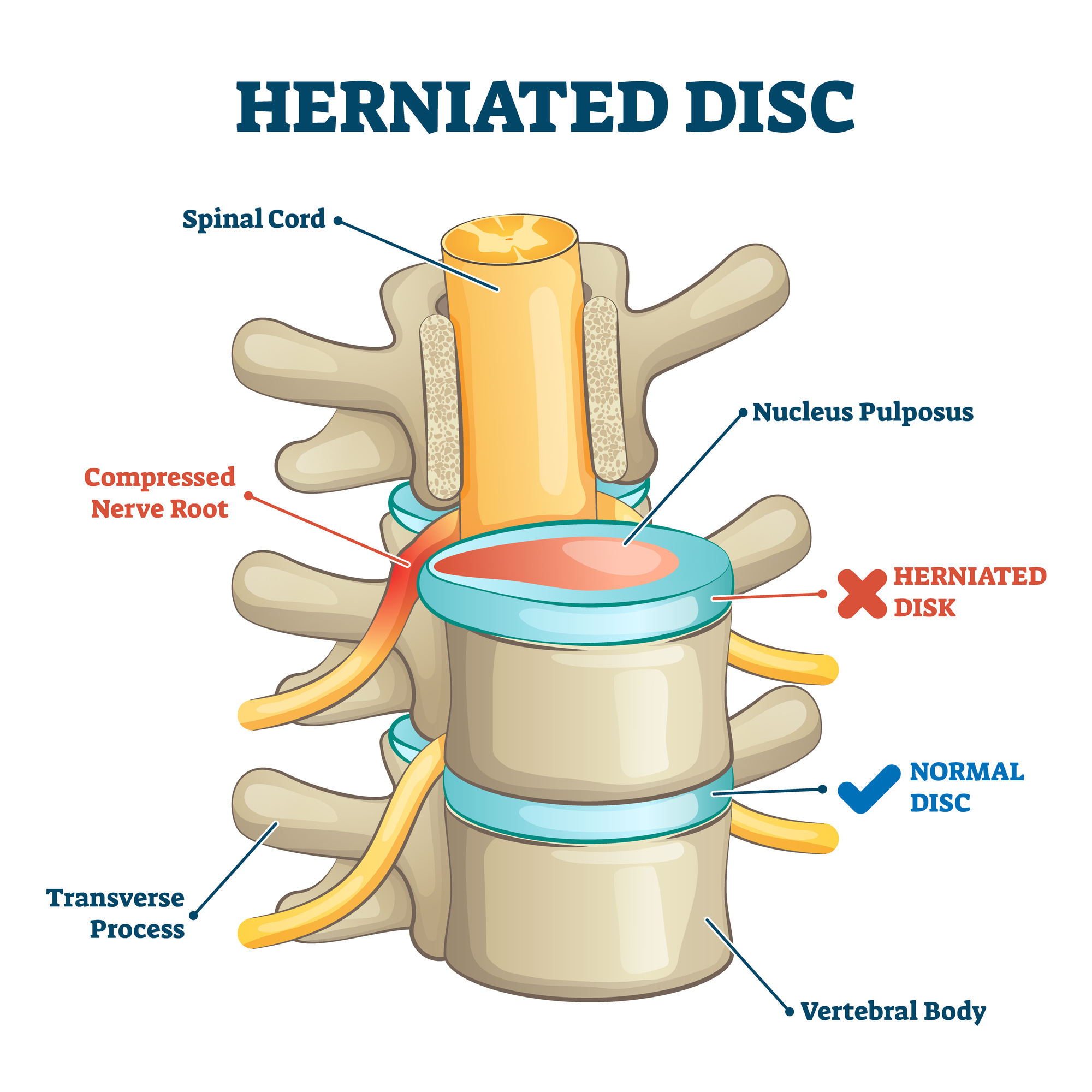 side view of herniated disc