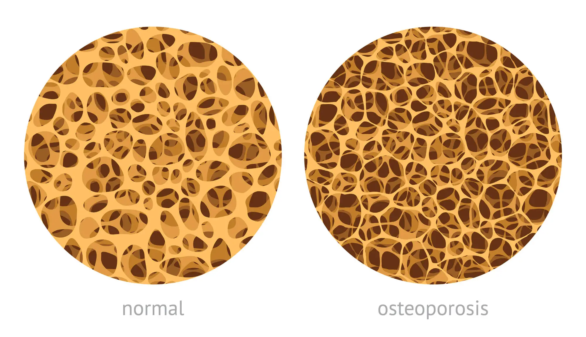 bone density: normal vs osteoporosis