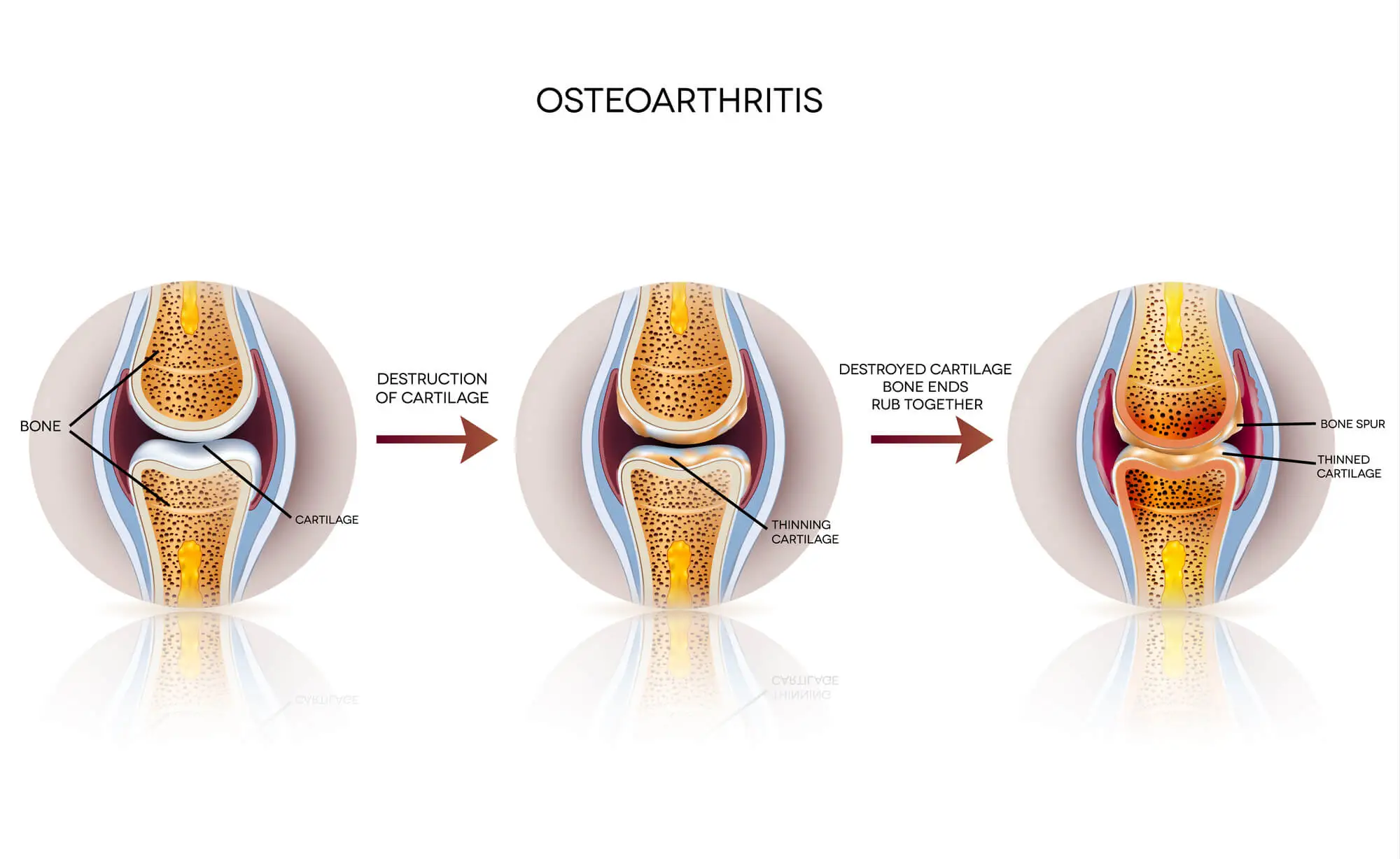 stages of osteoarthritis in the knee