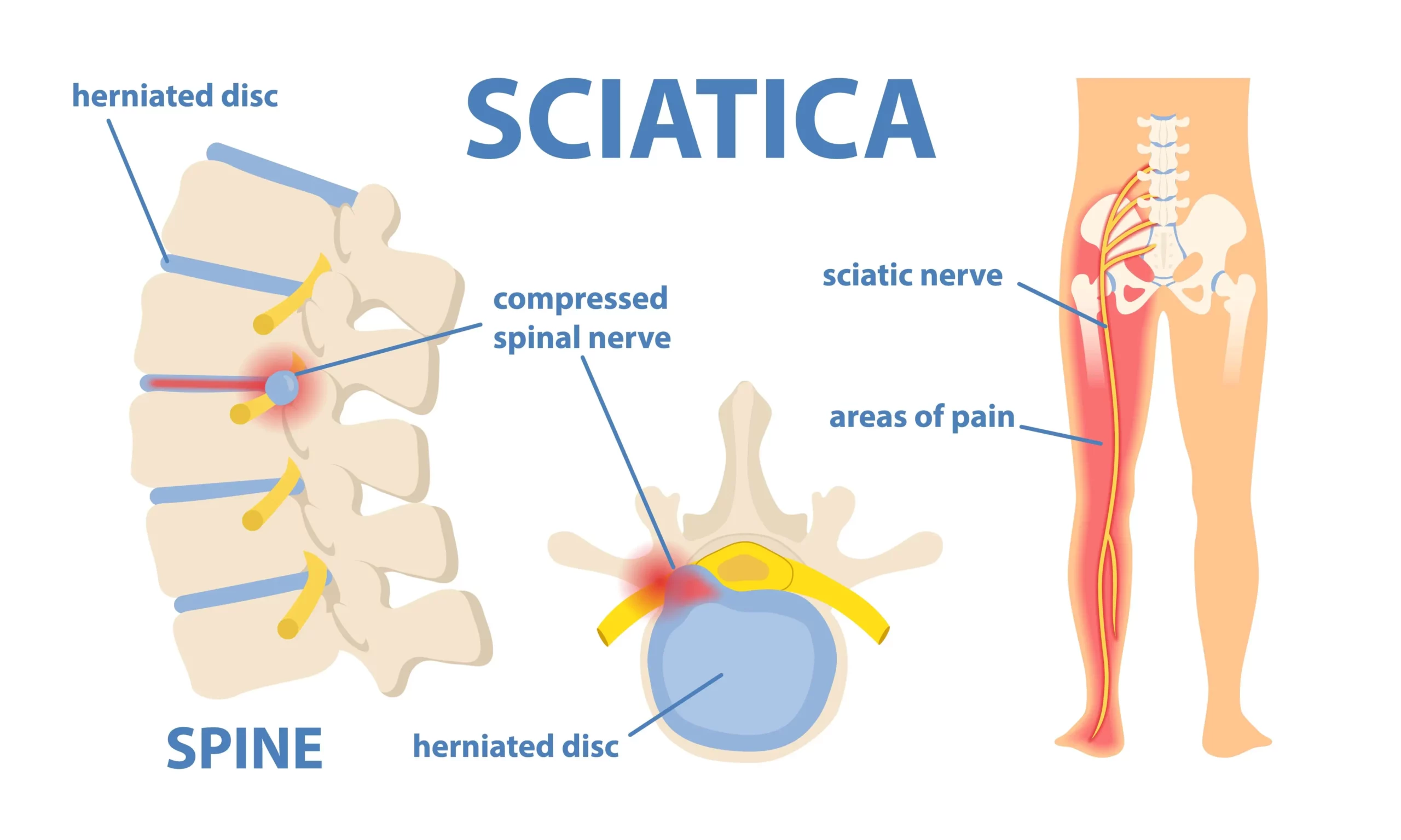 Sciatic nerve pain due to bulging or herniated disk
