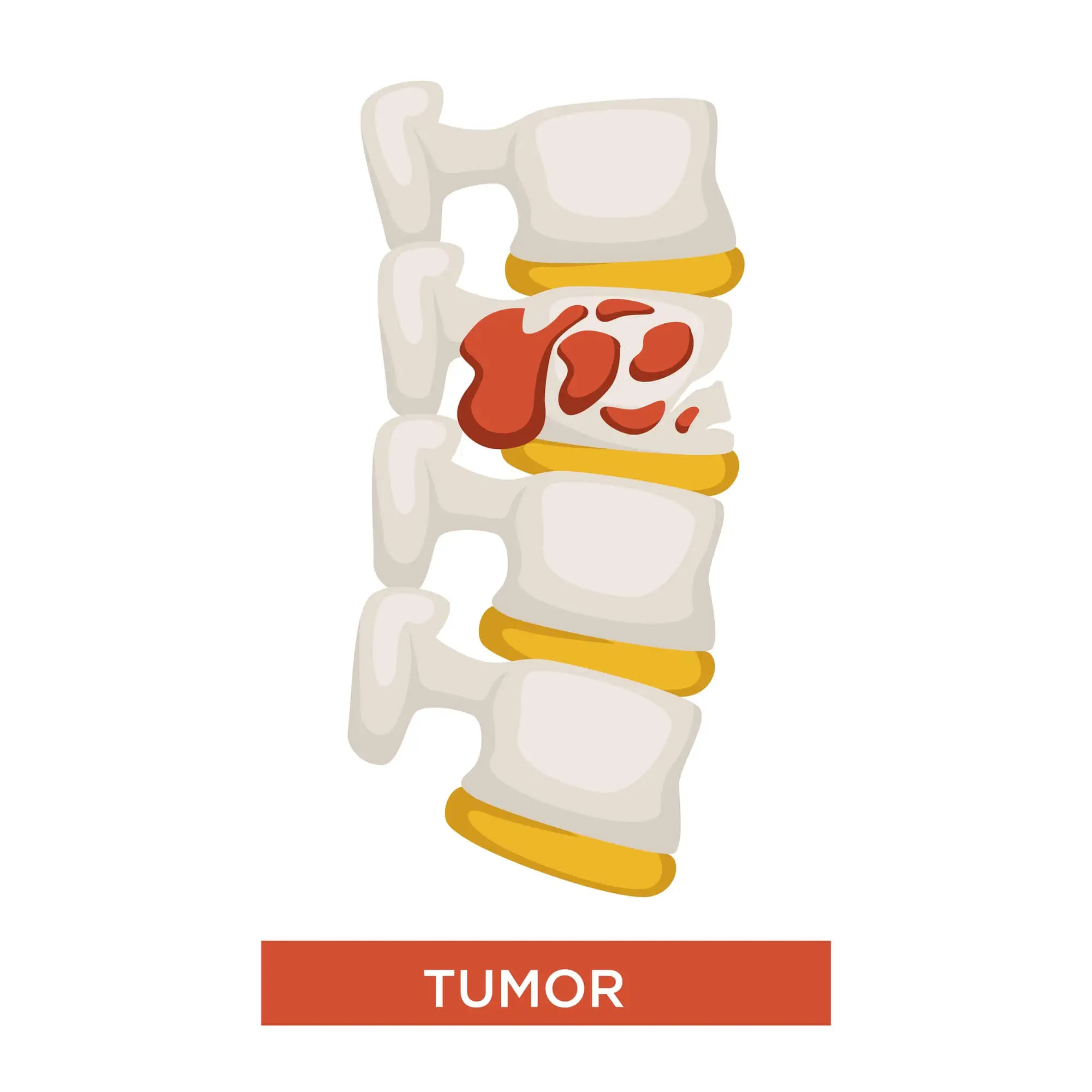 tumors on the spine