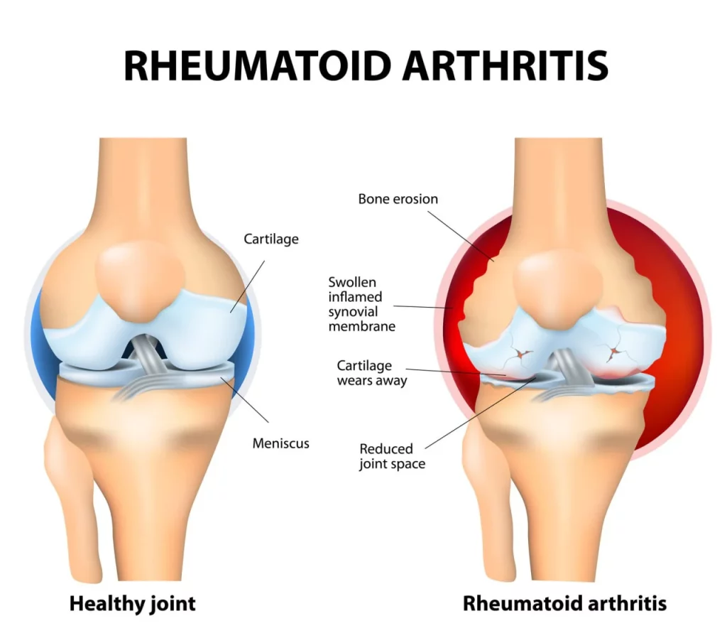 Rheumatoid Arthritis in the knee