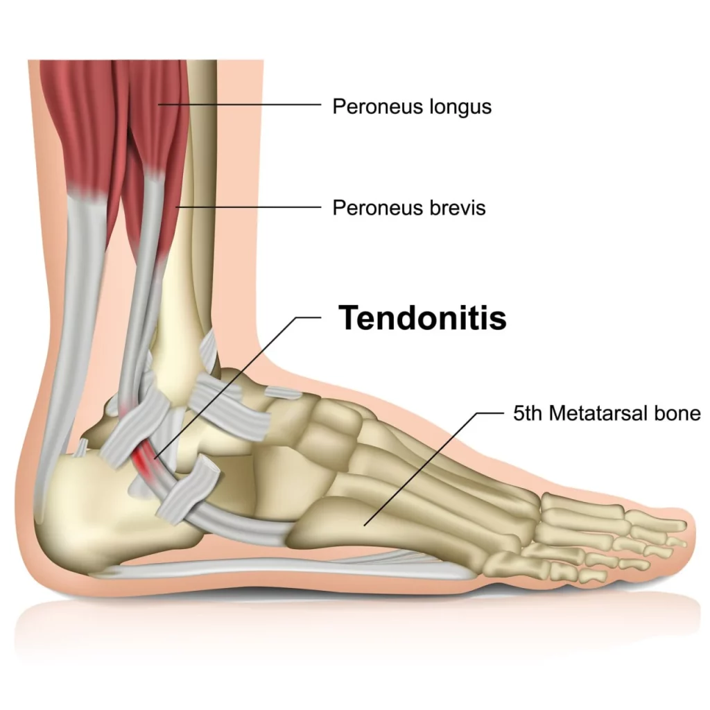 Ankle tendonitis