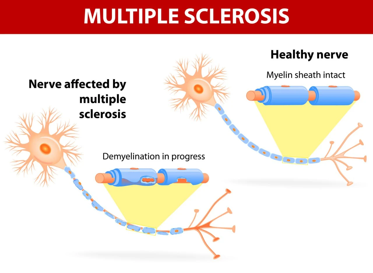 nerves affected by multiple sclerosis