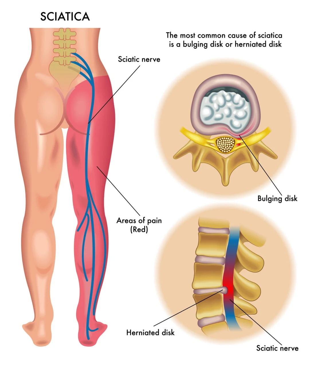 The most common cause of sciatica is a bulging disk or herniated disk. Image of sciatic nerve in lumbar down to feet and then images of herniated and bulging disk to the right