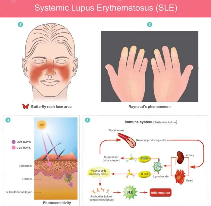 systemic lupus erythematosus (SLE)