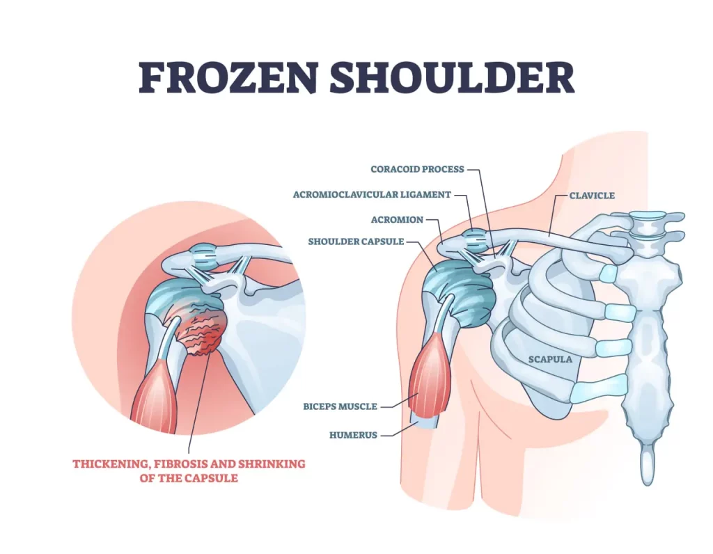 frozen shoulder anatomy