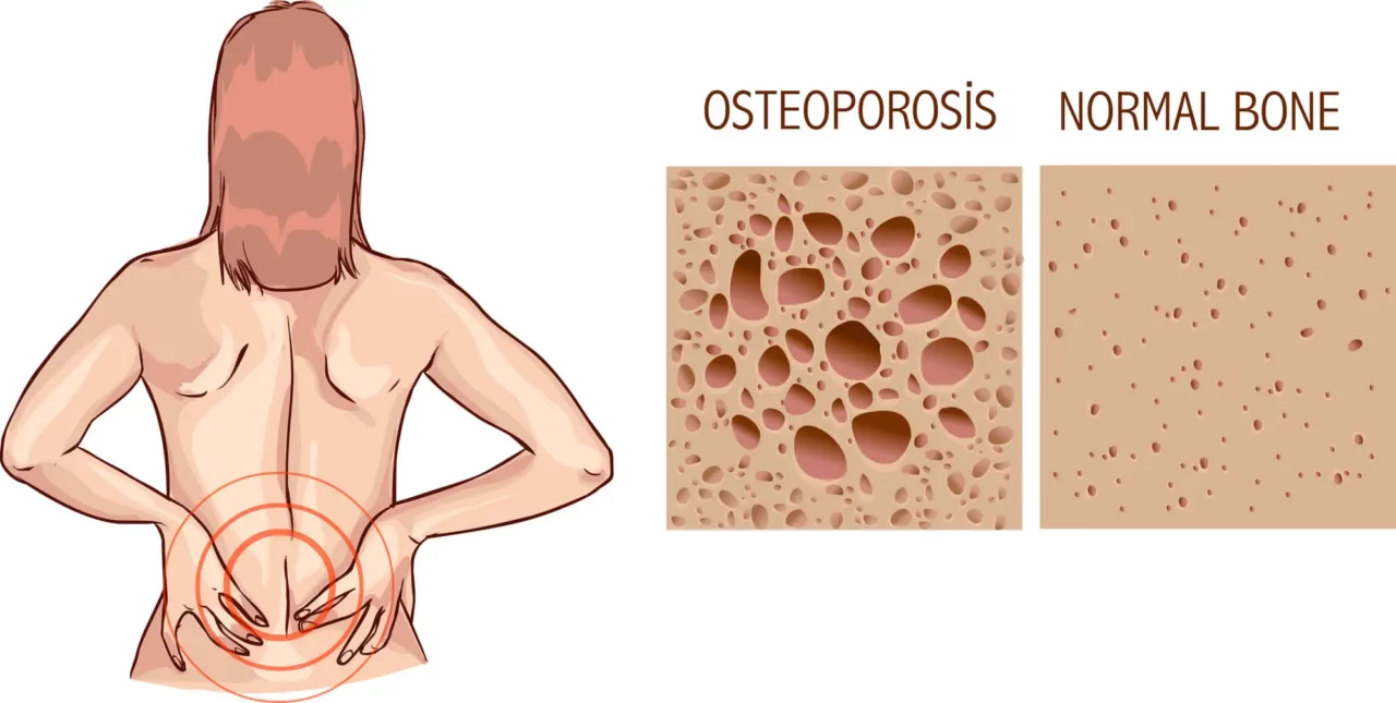 Osteoporosis vs normal bone
