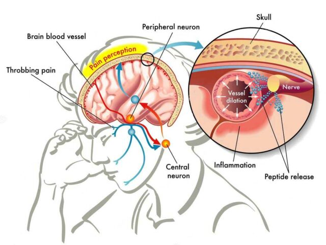 anatomical changes during a migraine involving the peripheral neuron, Central neuron, and blood vessels. They dilate 