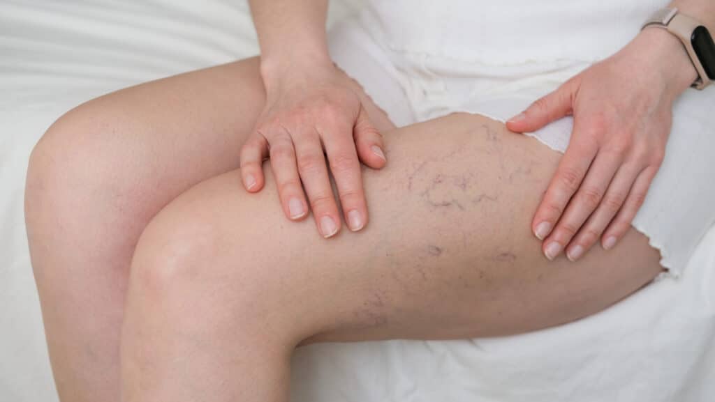 Relatyv - Varicose Veins