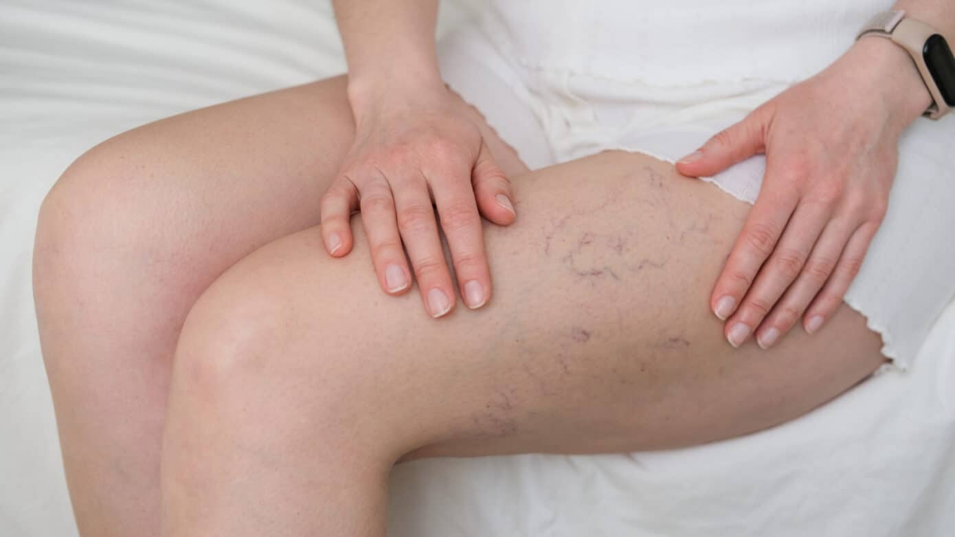 Relatyv - Varicose Veins