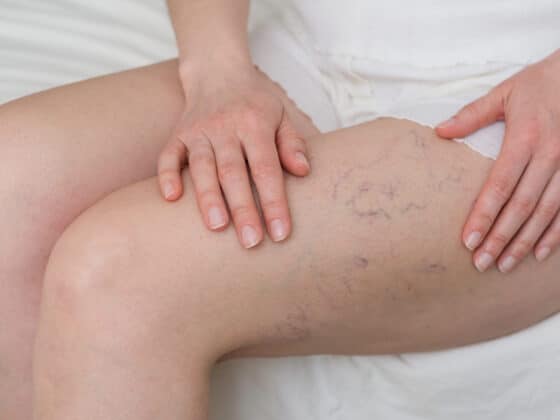 Relatyv - Varicose Veins